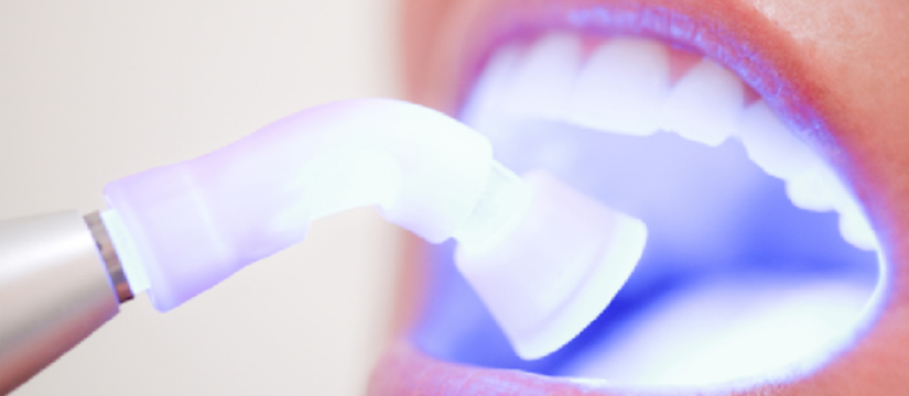 Laser versus gel teeth whitening